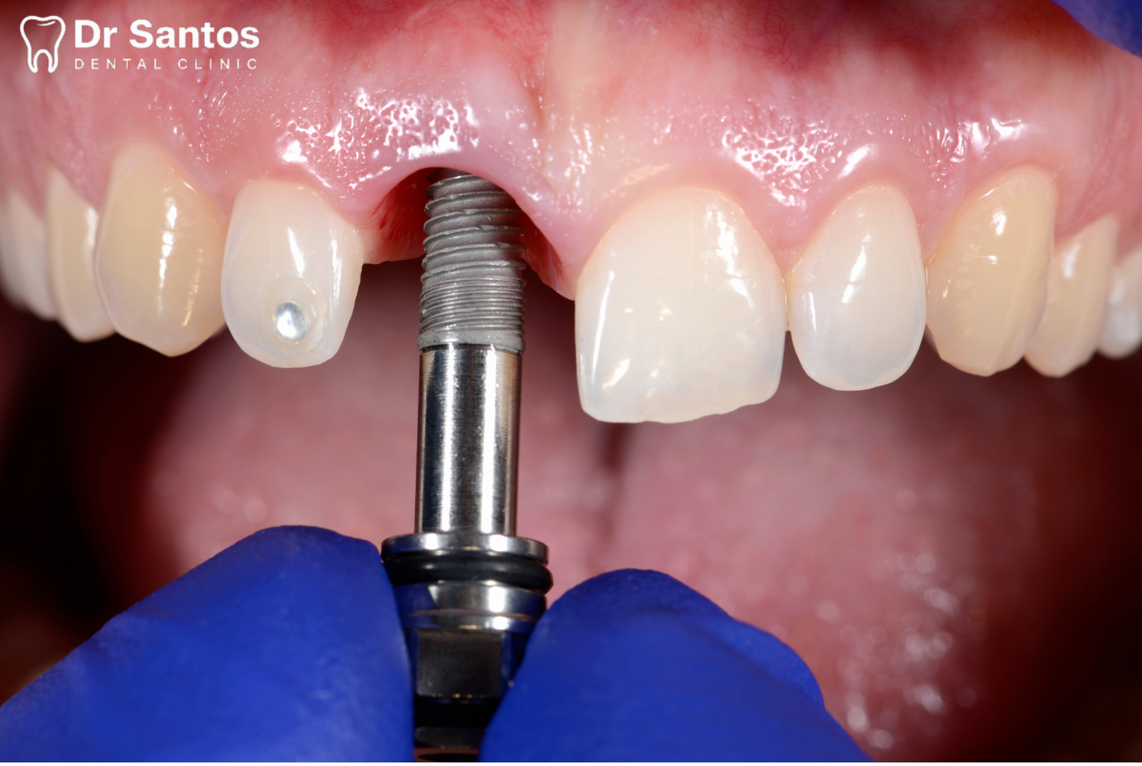 Ilustración de cómo un implante dental se integra en el hueso.